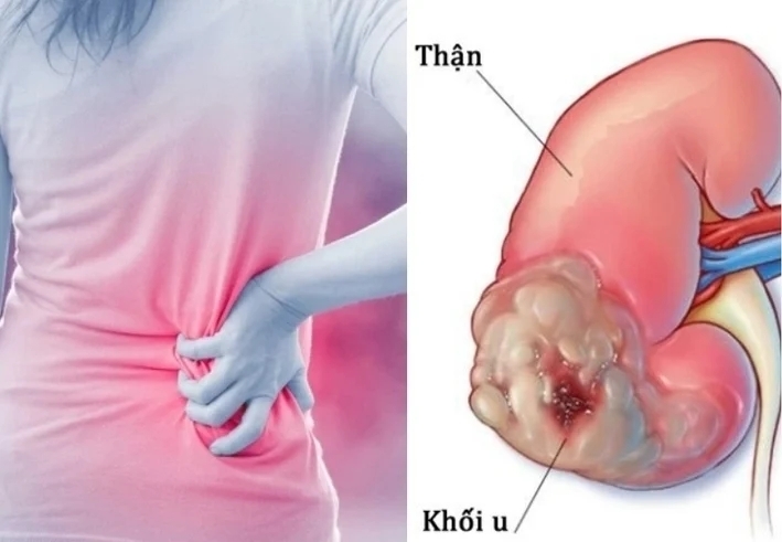 ung thu than 1 05553787 - Dấu hiệu thầm lặng cảnh báo ung thư thận